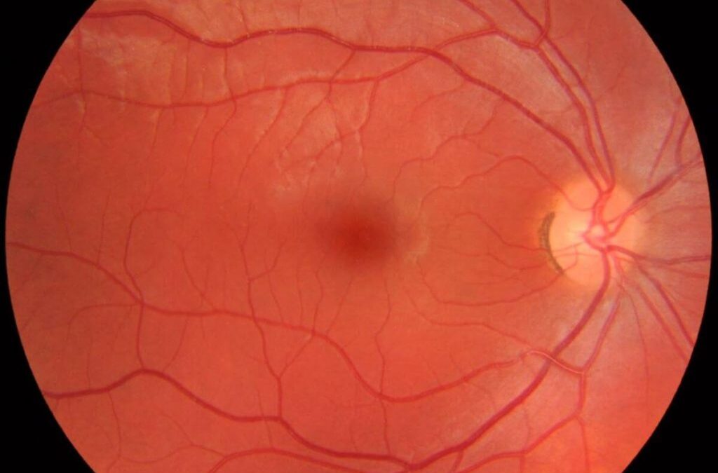 a retinal photograph