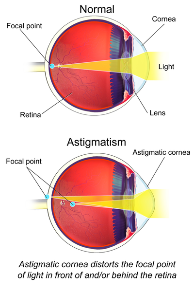 Az asztigmatizmus myopia vagy hyperopia
