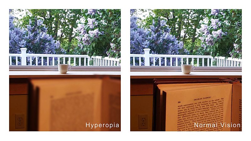 comparison of hyperopia with normal vision