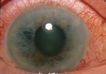 Important Information About Glaucoma You Should Know