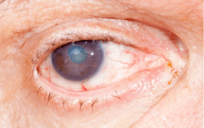 Cataracts: What You Need to Know