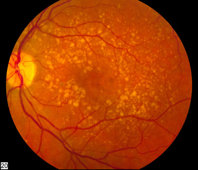 Macular Degeneration Information: What You Need to Know