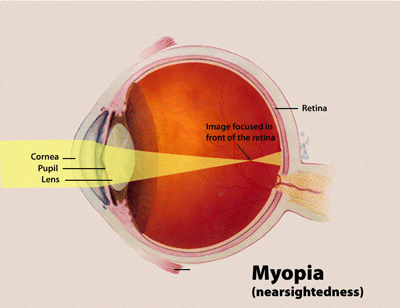 a graphic image of myopia