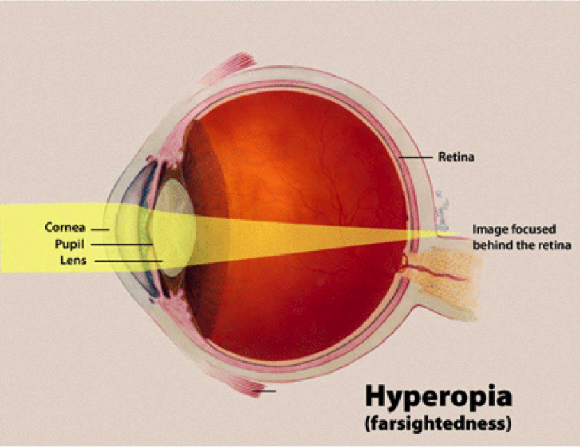 miért fordul elő hyperopia és myopia