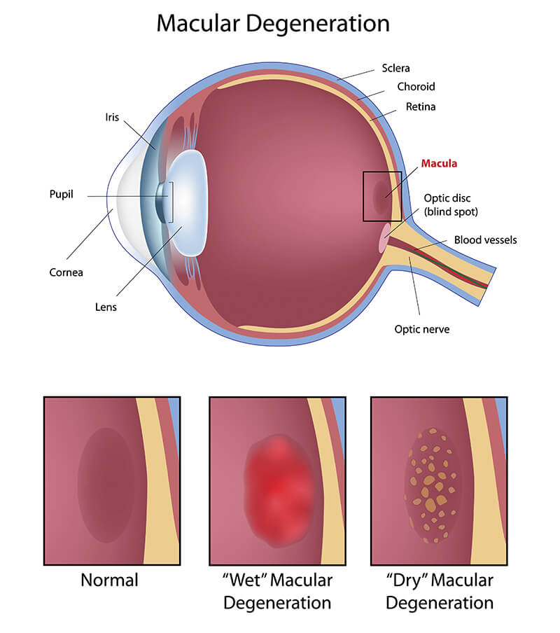 diagram showing the 3 different types of macular degeneration