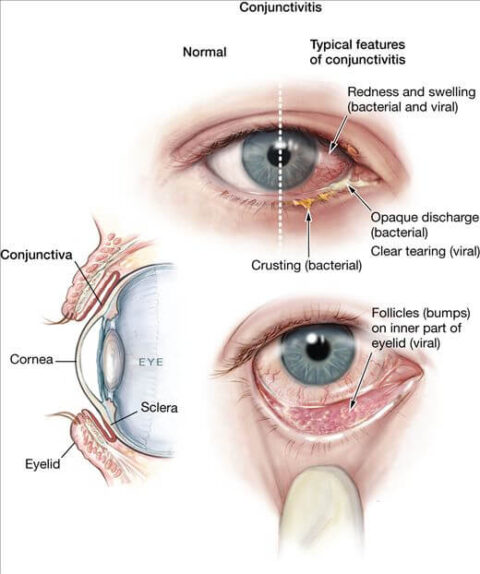 Tatum Eyecare | Important Pink Eye Information To Know
