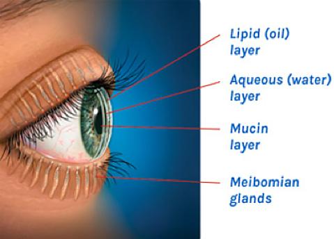 Types of Dry Eye